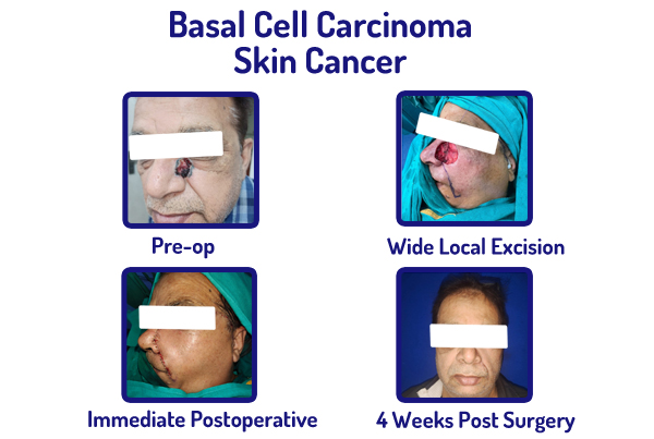 Skin Cancer Surgeon